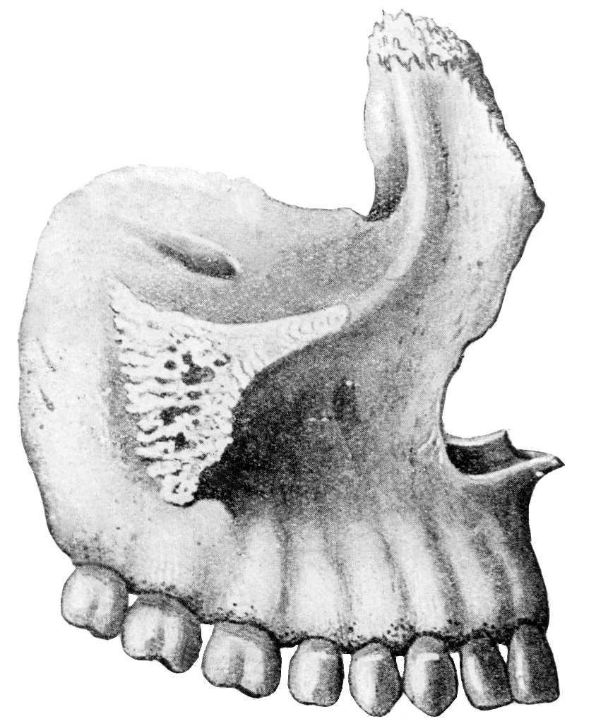 Клыковую ямку. Верхняя челюсть кость анатомия. Верхняя челюсть (Maxilla). Клыковая ямка верхней челюсти. Верхнечелюстная кость анатомия.
